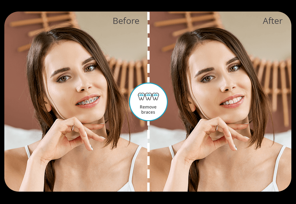 braces filter cover